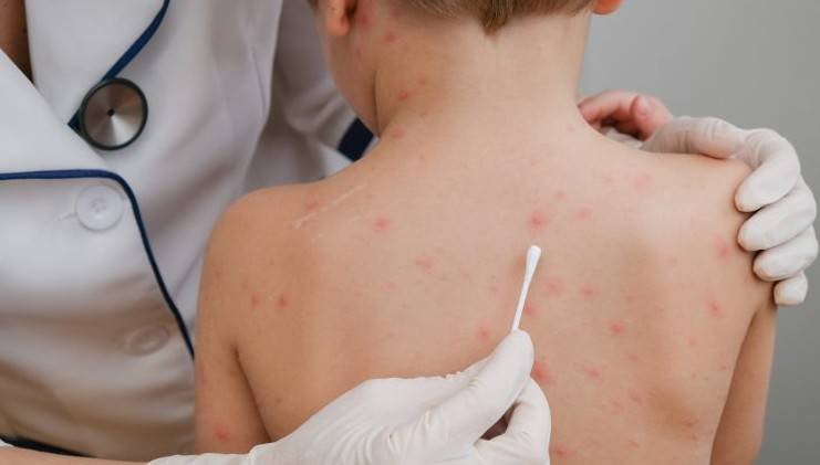 Mantiene Coahuila alerta por sarampión en Texas